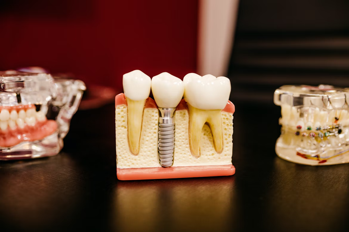 Reasons Why You Might Need to Get Dental Implants